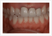 Dental Veneers - Before 1
