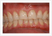 Dental Veneers - Before 3