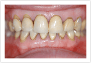 Dental Veneers - Before 4